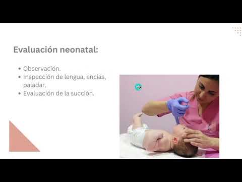 Thumbnail: Fisura Labio Alveolo Palatina (FLAP). Todo lo que tenés que saber.